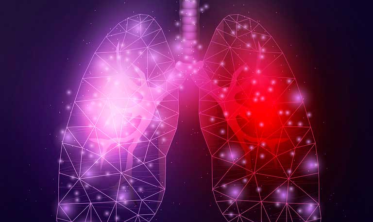 Abstract imagery of lungs with sarcoidosis
