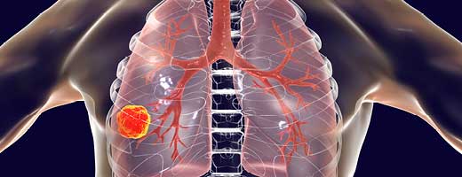 Illustration of cancer in the lungs