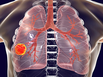 A bag of platelets hangs for a transfusion
