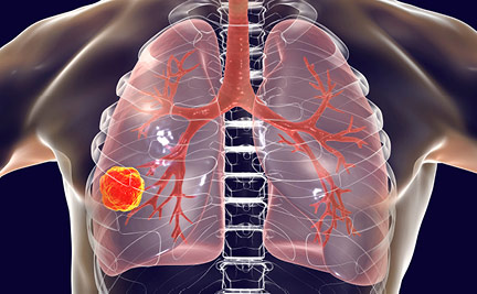Management of Patients With Early-Stage Non-Small Cell Lung Cancer