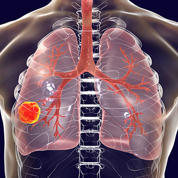 Illustration of cancer in the lungs